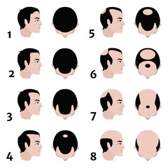 Stages of baldness according to the Norwood scale. Vector flat illustration
