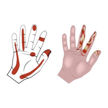 Pyoinflammatory processes of hands and fingers. Infographic with affected areas. Vector illustration