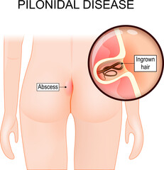 Pilonidal disease. skin infection. Close-up of a cyst with Ingrown hair - obrazy, fototapety, plakaty