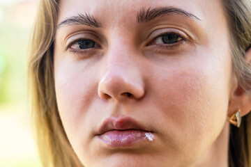 Herpes on the lips of young woman. Close up