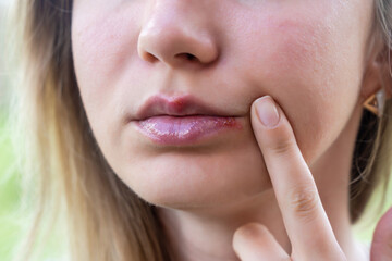 Obraz premium Herpes on the lips of young woman. Close up