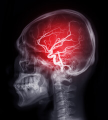 Skull image fusion with MRI MRA Brain  for evaluate them  stenosis  and stroke disease.