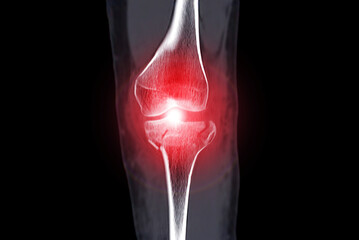 CT Scan of Knee joint Axial .