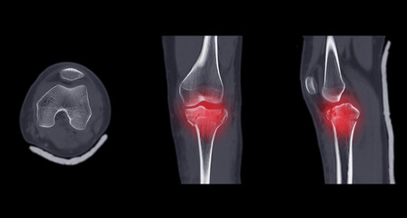 CT Scan of Knee joint Axial .