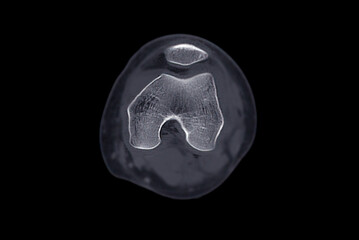 CT Scan of Knee joint Axial .
