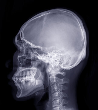  Skull x-ray image of Human name is skull lateral view isolated on Black Background.
