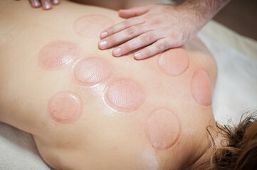 Red marks on a woman's back after removing acupuncture treatment. Ventosa traditional massage,...