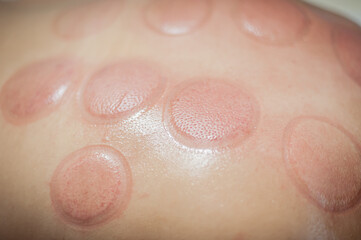 Red marks on a woman's back after removing acupuncture treatment. Ventosa traditional massage,...