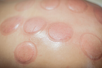 Fototapeta premium Red marks on a woman's back after removing acupuncture treatment. Ventosa traditional massage, vacuum cupping therapy. Alternative Medicine.