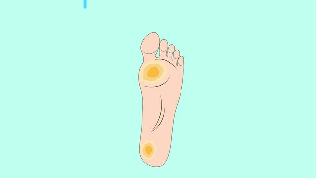Wart verrucas plantar. Fasciitis Wart on foot. Decease on foot skin. Wart plantar callus foot with endless loop animation.
