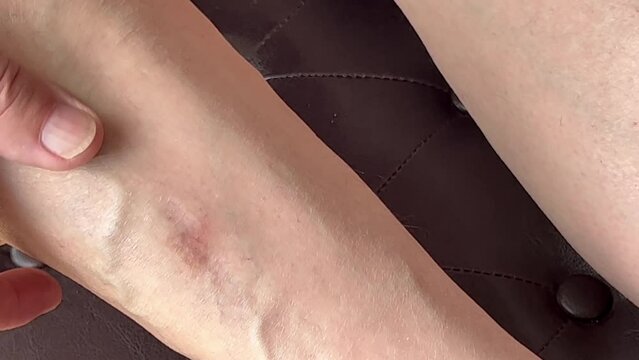 Man looks at varicose veins on legs 