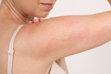 Skin redness and itching concept. Sensitive Skin, Food allergy symptoms, Irritation
