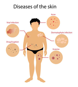 illustration of biology and medical, Diseases of the skin, Skin disorders vary greatly in symptoms and severity, Pictures of different skin disorders, Chronic skin disease