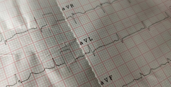Test record of electrocardiogram (ECG or EKG) heart beat rate or rhythm frequency wave line graph report on paper. Life, health care, diagnosis, health, cardiology and medical concept. Close up view.