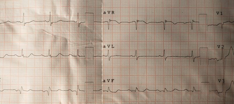 Test record of electrocardiogram (ECG or EKG) heart beat rate or rhythm frequency wave line graph report on paper. Life, health care, diagnosis, health, cardiology and medical concept. Close up view.