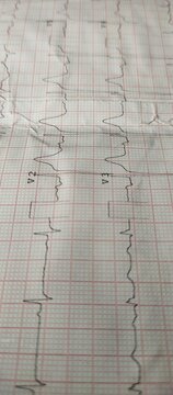 Test record of electrocardiogram (ECG or EKG) heart beat rate or rhythm frequency wave line graph report on paper. Life, health care, diagnosis, health, cardiology and medical concept. Close up view.