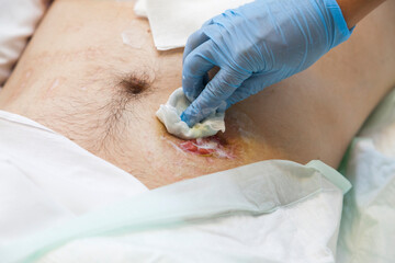 Close up stoma and colostomy after colon cancer surgery out.Cover stoma with one piece colostomy...