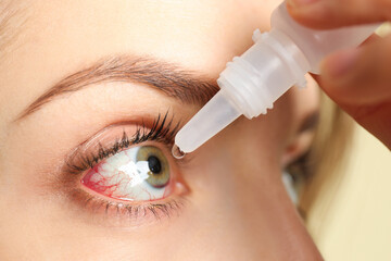 Woman using eye drops on light background, closeup