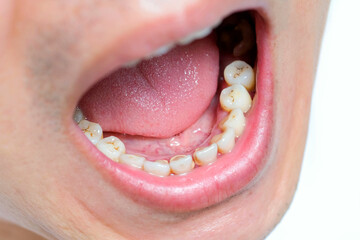 Fototapeta premium Tooth's a man smoking bad. woman smokes a cigarettes have tooth decay and calculus on teeth, So we should be care dental with the hygiene.