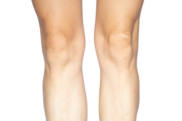 Women's legs with a scar on her knees on a white background, photo without retouching, close up of...