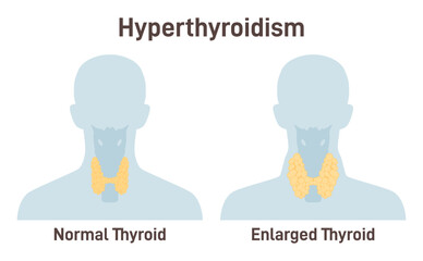 Hyperthyroidism. Thyroid gland produces too much of the hormone