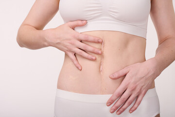 Close-up of young woman in underwear showing her scar on belly isolated on white background