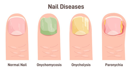 Onychomycosis, onycholysis, paronychia. Nail diseases, nail fungal