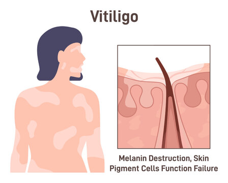 Vitiligo. Leucoderma skin anatomical structure. Long-term skin