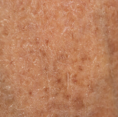 Fototapeta premium dry keratinized skin as a background