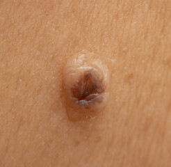damaged mole on the skin