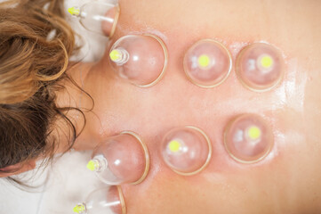 Glass vacuum cupping therapy on a woman's back, acupuncture treatment. Ventosa traditional massage....