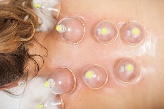 Glass vacuum cupping therapy on a woman's back, acupuncture treatment. Ventosa traditional massage. Alternative Medicine. Medical health care
