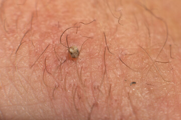 Swollen bee sting site, redness on the skin from a bee sting.