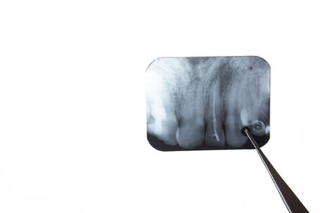 Cyst X-ray of the tooth. Radicular cyst of the upper jaw. Pathological formation, a tumor in the tooth is visible on the x-ray. © Binkontan
