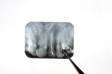 Cyst X-ray of the tooth. Radicular cyst of the upper jaw. Pathological formation, a tumor in the tooth is visible on the x-ray. © Binkontan