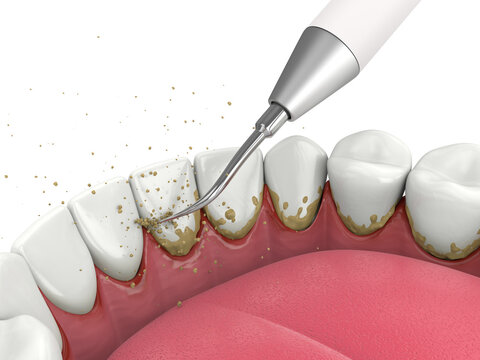 Descaling tartar and plaque from teeth by ultrasonic scaler