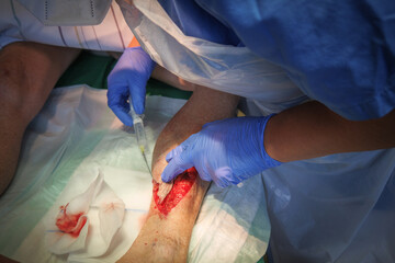 a laceration on the lower leg is locally anesthetized