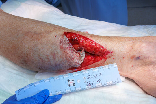 a laceration on the lower leg is measured with a ruler