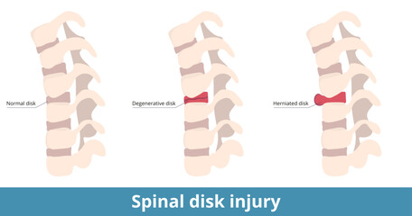 Spinal disk injury. The herniated disk causes pain, numbness, or weakness, and the degenerative disk results as dry out or cracking.  Causes of spinal pain and damage. - obrazy, fototapety, plakaty
