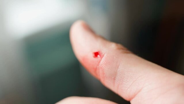 Close-up on a blurred background of a thumb with torn skin and slight bleeding. Wound on arm with bright red blood.