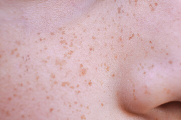 Freckles on a child's face. Close-up of skin spots