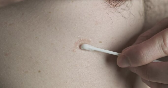 Smear the skin with a cotton swab. Close-up. Treatment of skin disease, red rash. Pink lichen, treatment, application of ointment.