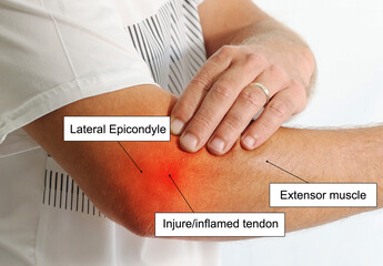 Chart explanation of lateral Epicondylitis or tennis elbow problem in man over use arm causes ...