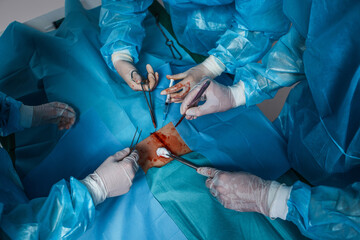 Shot of professional surgeons perfoming operation and treatment injured patient.