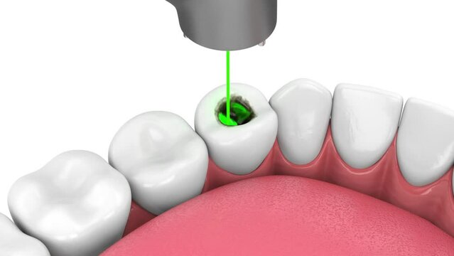 Removing tooth decay with dental laser without dental drill