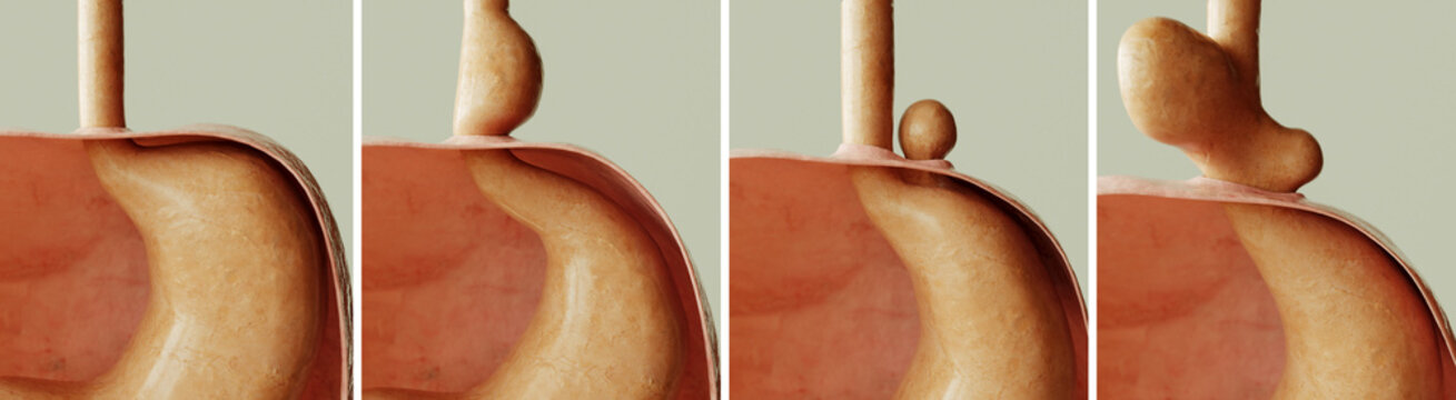 Hiatus hernia - Healthy and 3 types of diaphragmatic hernia - 3D rendering