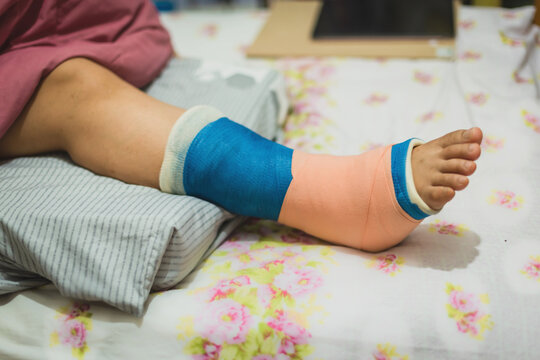Close-up Of A Women's Broken Leg .