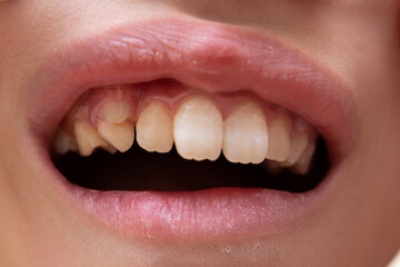 歯の生え変わりで二重に生えてきた子供の歯 - obrazy, fototapety, plakaty