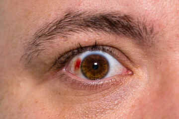 Eye injury, young man with burst blood vessel in eye, fatigue, problems with blood vessels