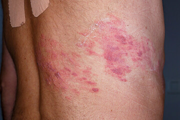 Fototapeta premium Skin lesion symptom in Shingles or Herpes zoster in human. Shingles or Herpes zoster is aviral disease caused by varicella zoster virus charatrized by a painful skin rash with blisters on the body.